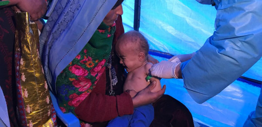 CH1653665 Khal Mirza 1 yr 3mnths is suffering from severe acute malnutrition and is being treated at Save the Childrens Mobile Health Clinic in Faryab Province